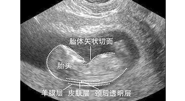 输卵管积水做试管_子宫切除后怀孕了_NT检查大揭秘！新竹市做三代试管婴儿孕